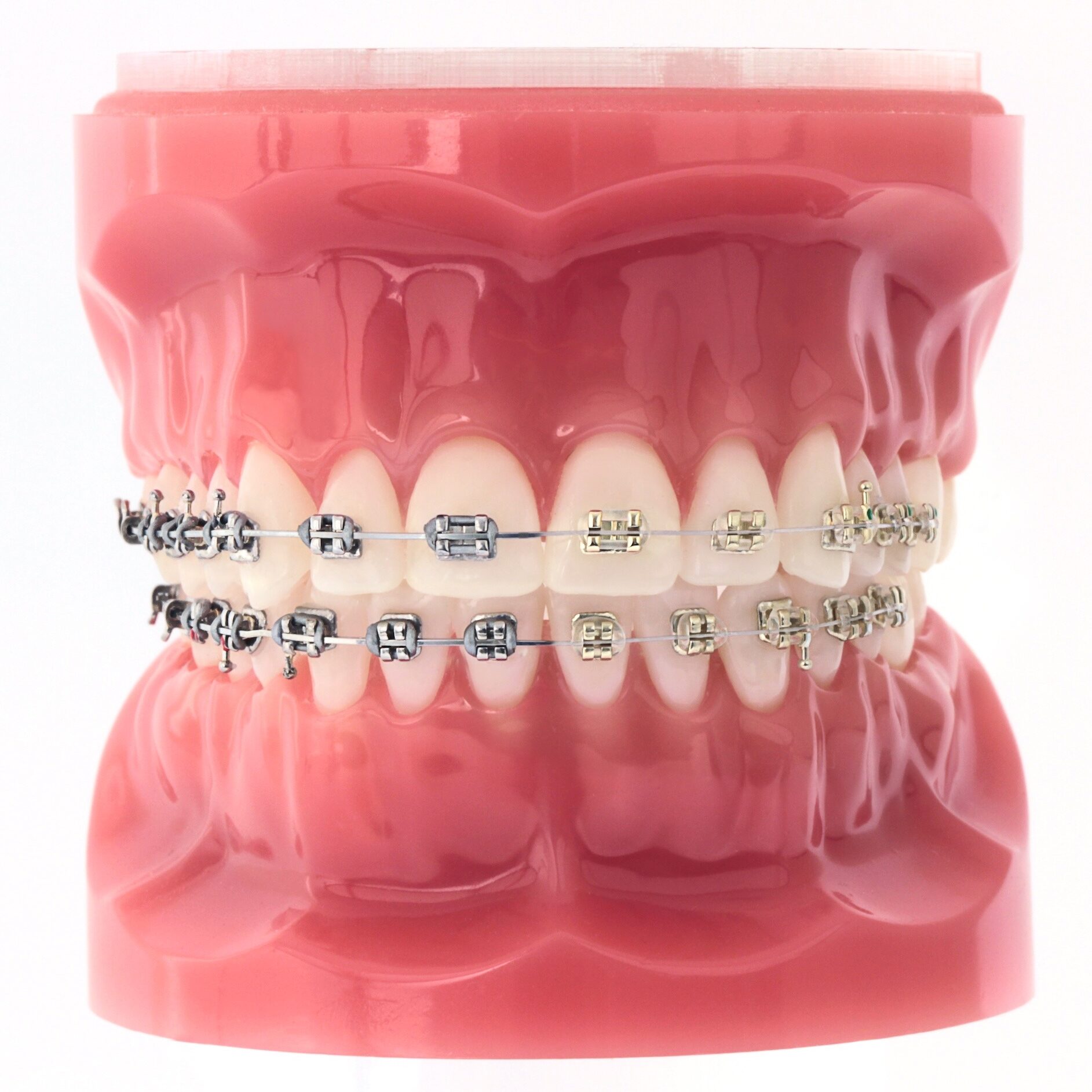 A model of braces on teeth where half the brackets are metal and half are a gold color.