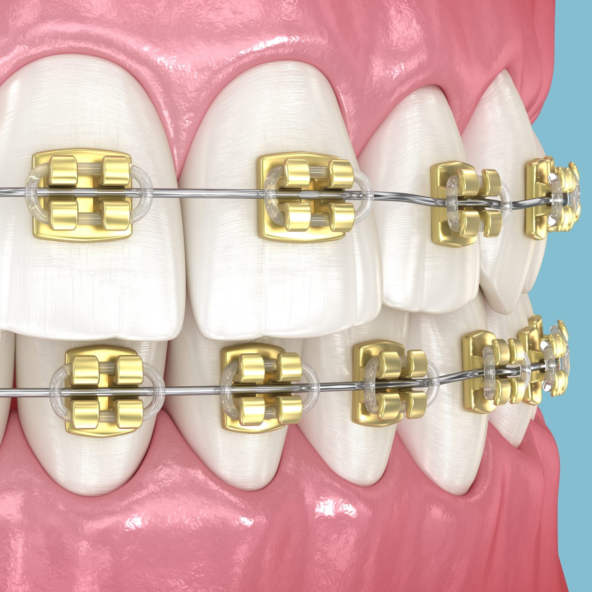 gold braces