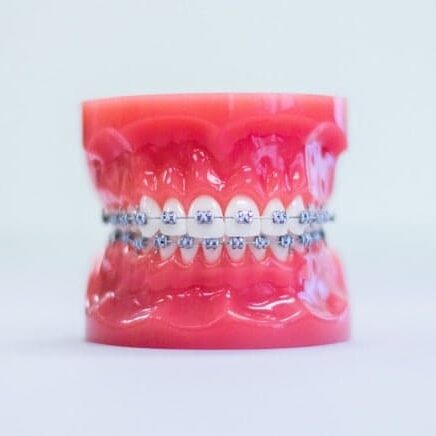 metal braces